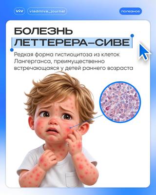 Болезнь Леттерера–Сиве: маскировка под стоматологические патологии.
